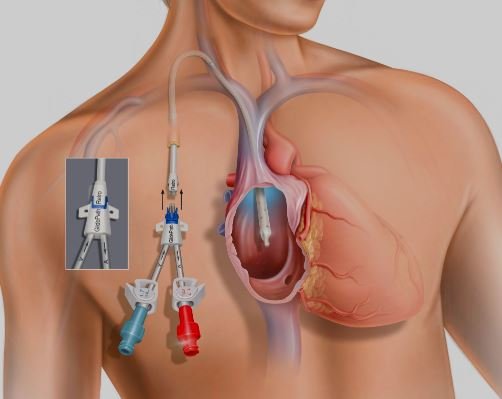 Dialysis Catheter